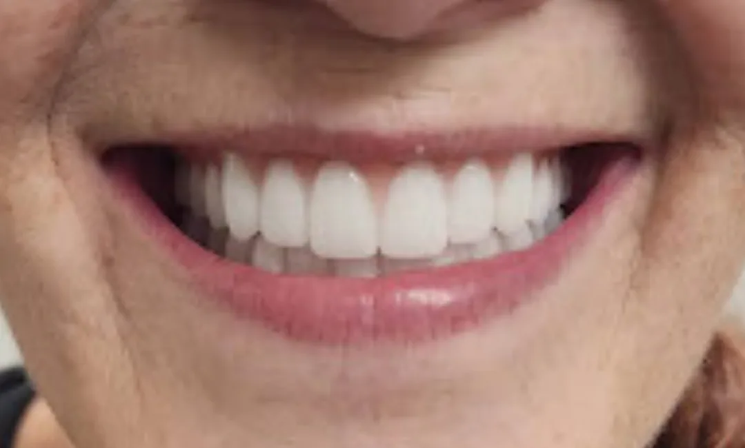After treatment
