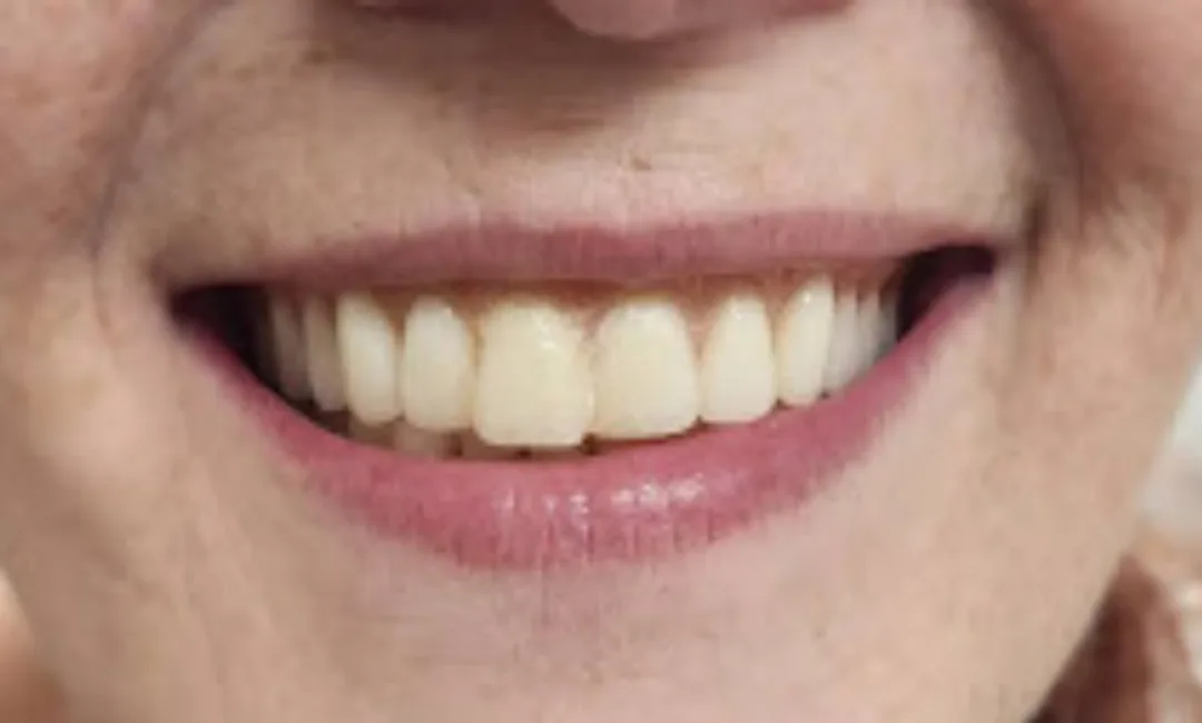 Before treatment