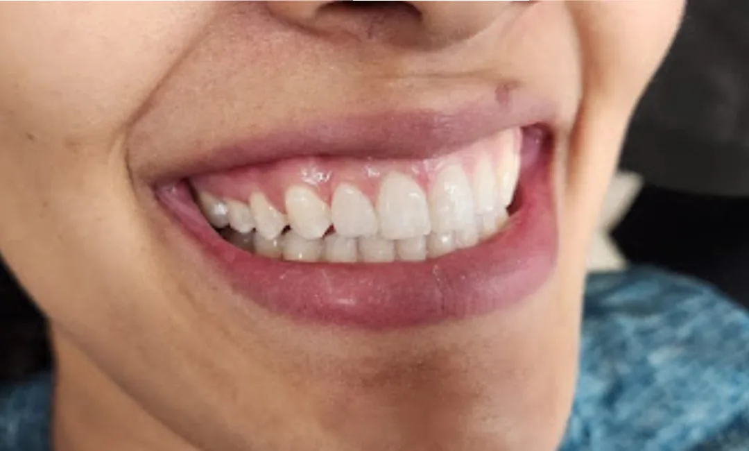 After: alignment and shade