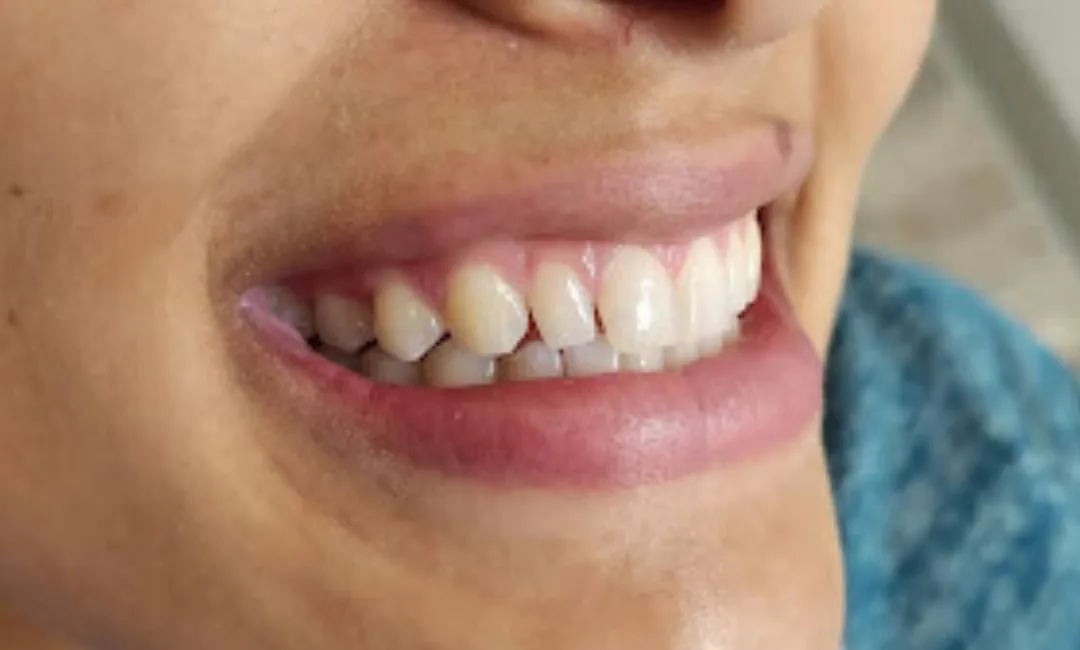 Before: alignment and shade