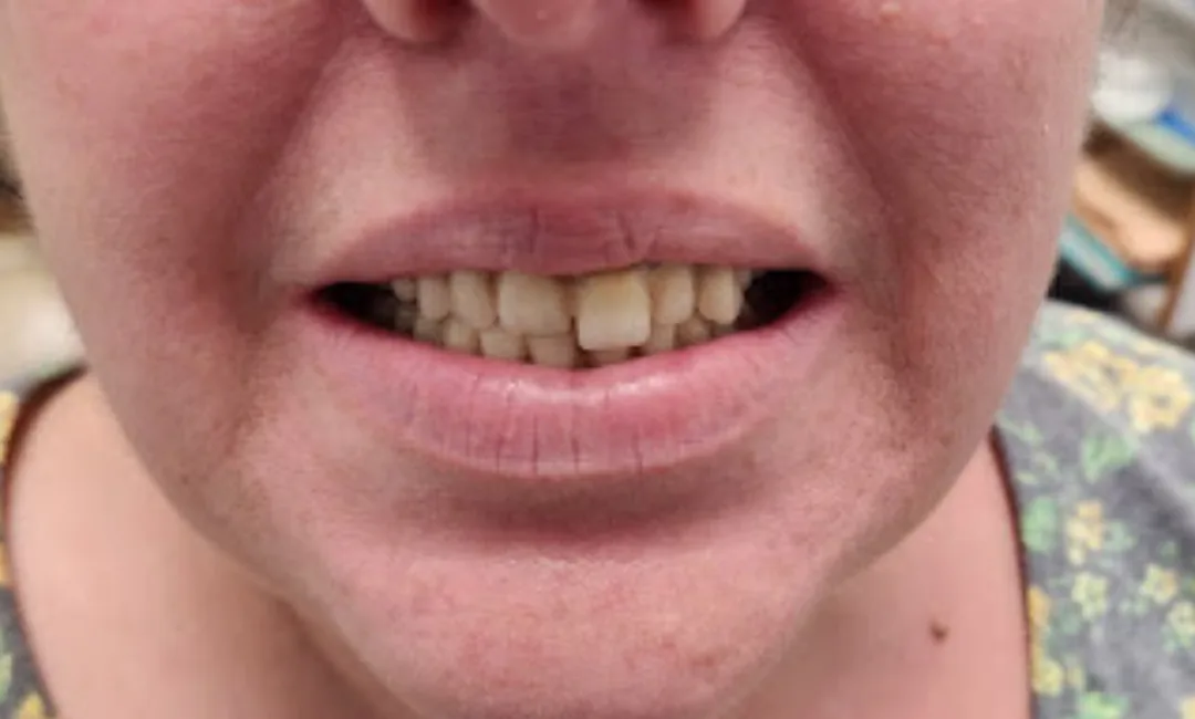 Before: a missing upper tooth and worn edges