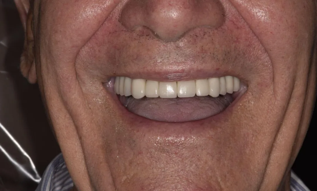 After: full upper arch