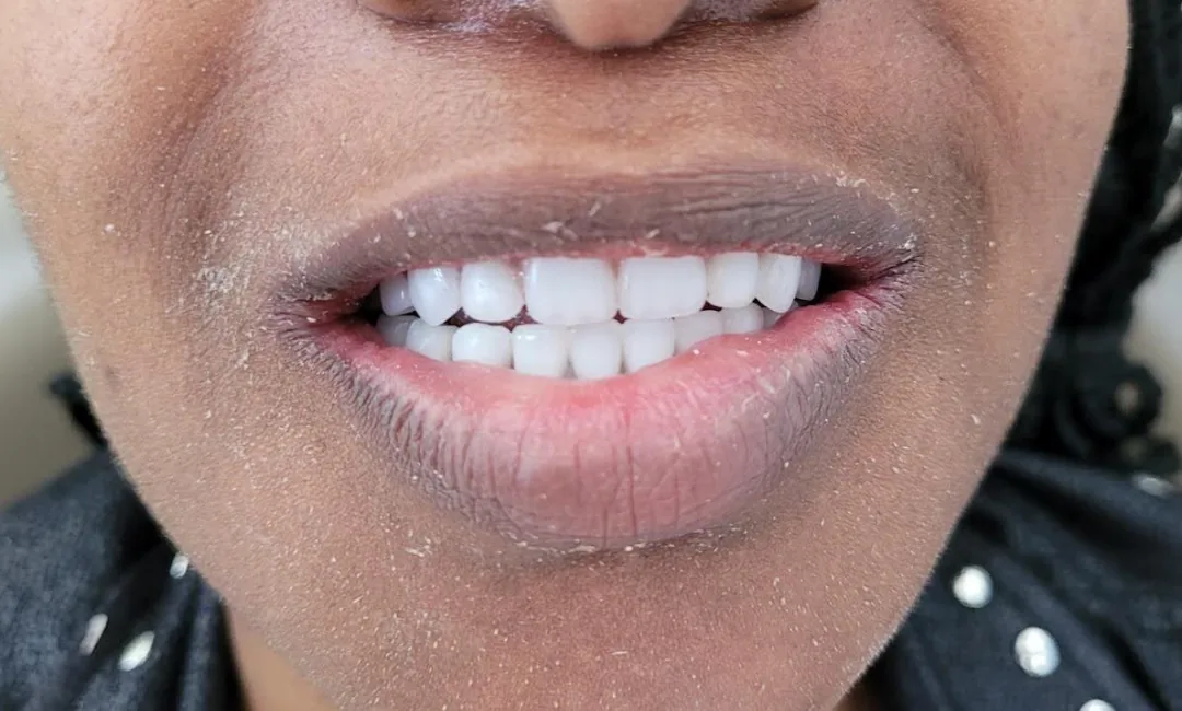 After: a bright, even upper arch