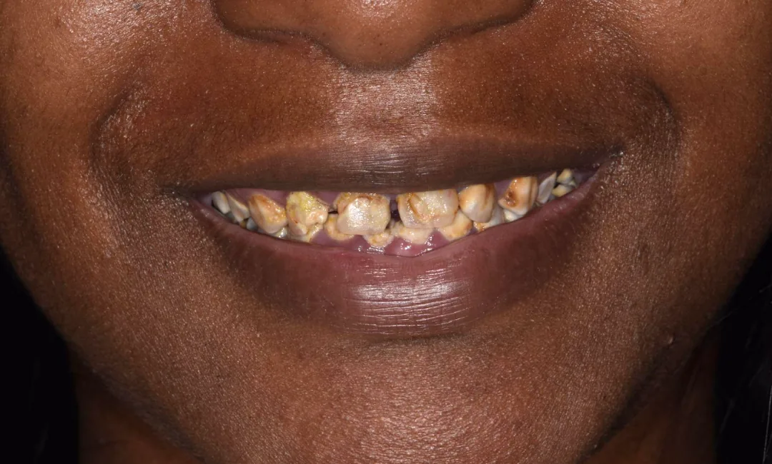 Before: heavily stained and crowded upper teeth